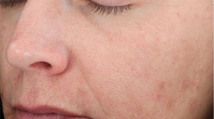 SkinMedica Vitalize Before and After