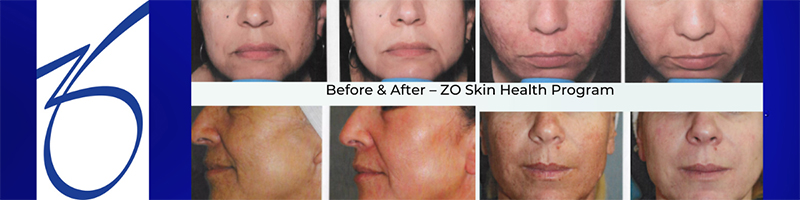 ZO Skin Health Program Before & After results